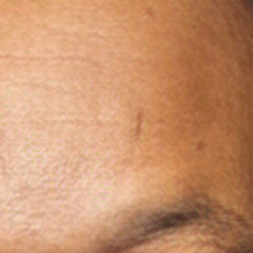 RefSTAR forehead detail